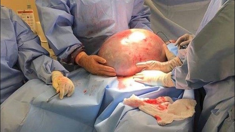 Alabama woman's unexplained weight gain turns out to be 50-pound