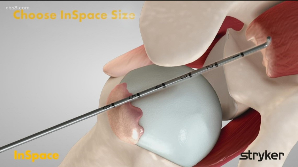 Explaining new technology of Novel Balloon Implant for Rotator Cuff