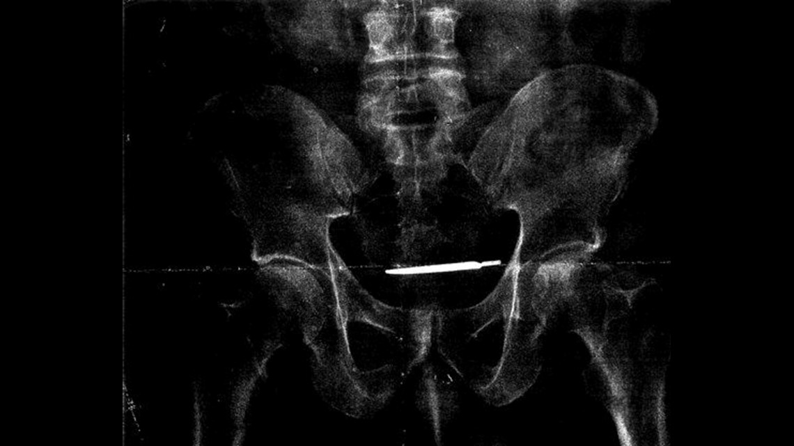 Army vet sues VA over scalpel left in body after surgery