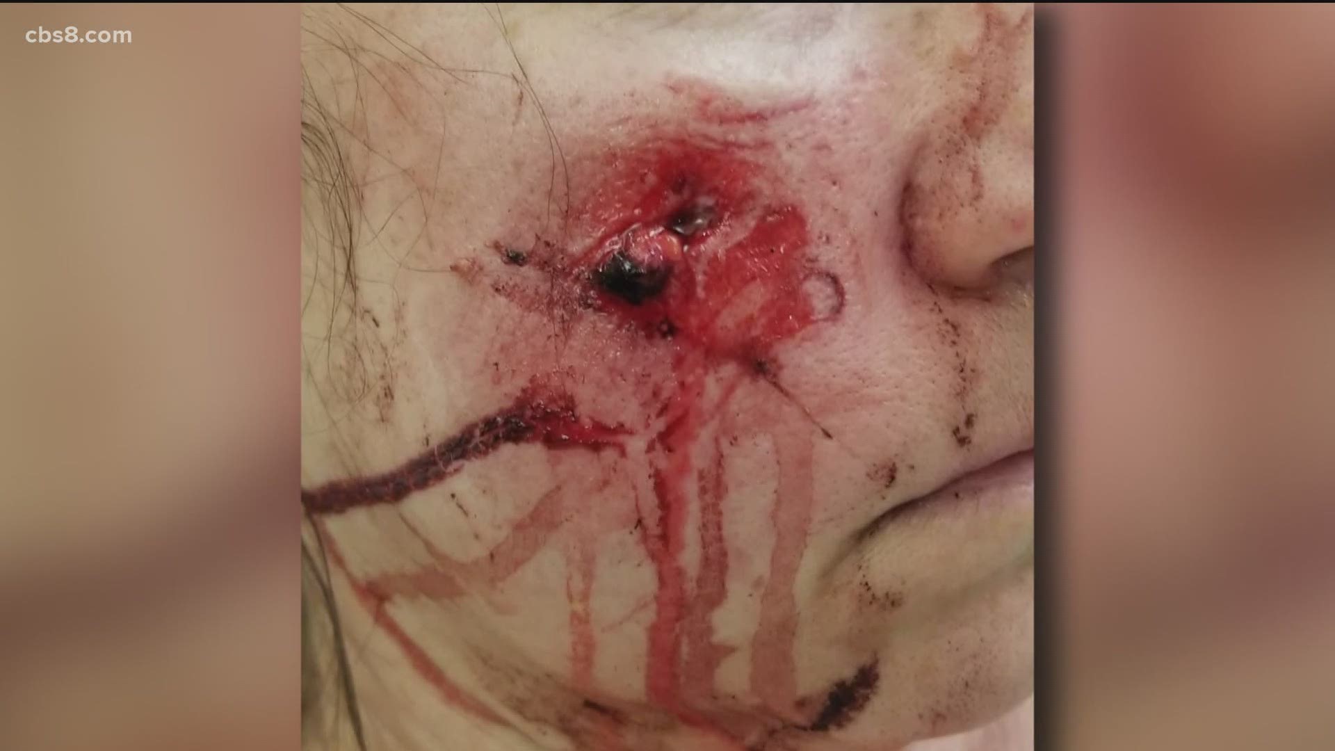 David Gotfredson reports a second woman has come forward saying she was shot in teh face with a police projectile at Saturday's protest in La Mesa.