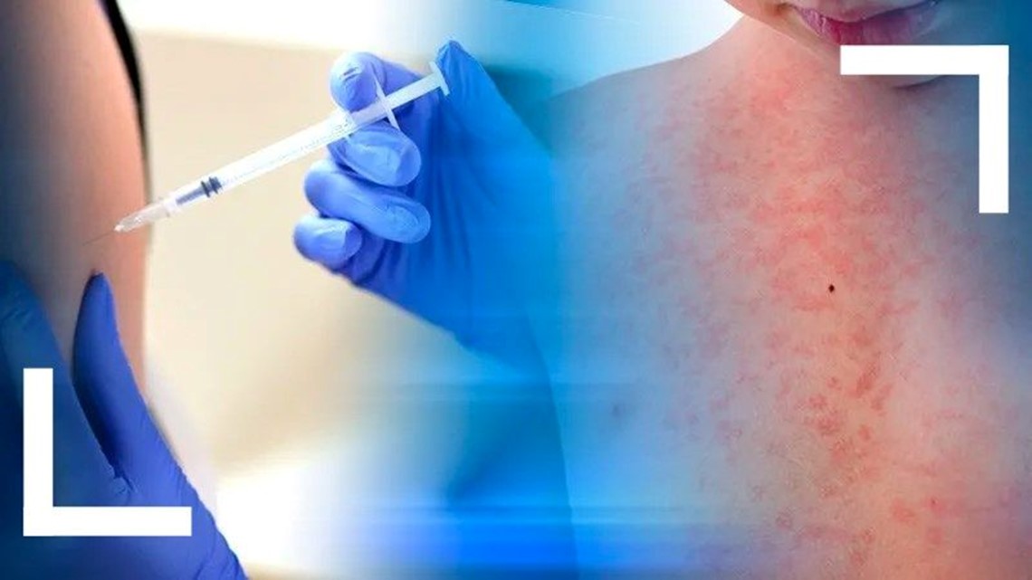 CDC monitoring increase in measles cases in 21 states, including ...