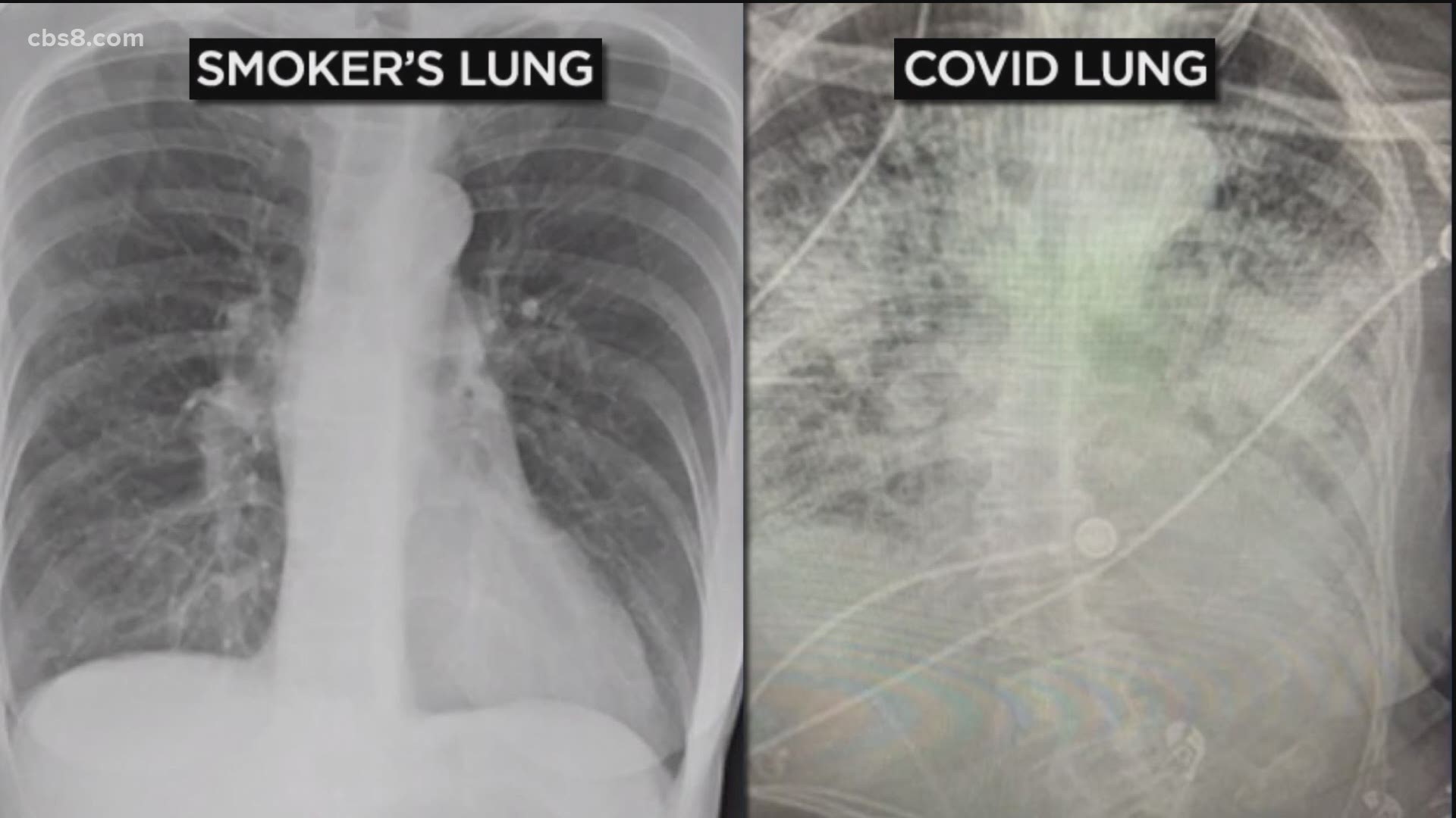 healthy lungs vs smokers lungs x ray