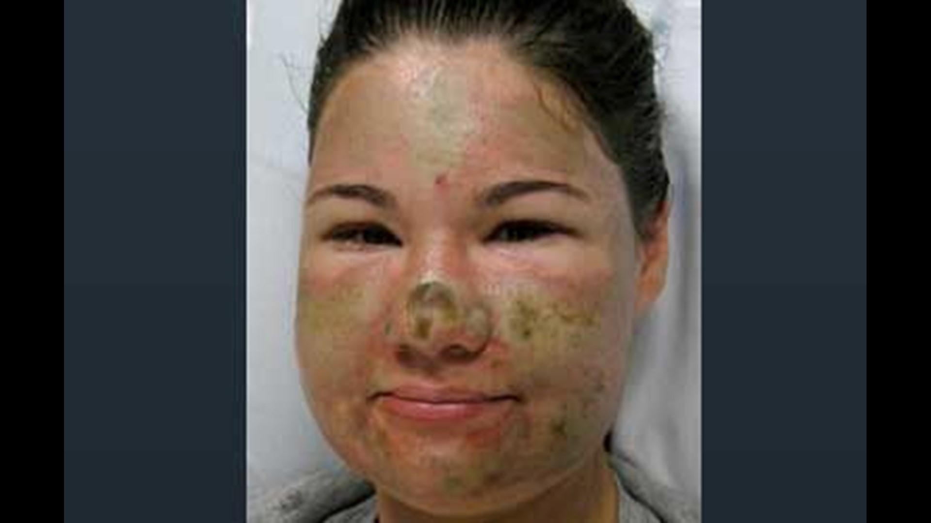 Police Woman Could Be Charged In Self Inflicted Acid Attack