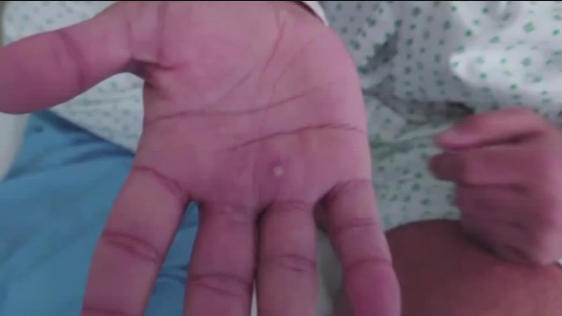 There are 27 confirmed monkeypox cases in San Diego county and another 19 listed as probable, according to county leaders.