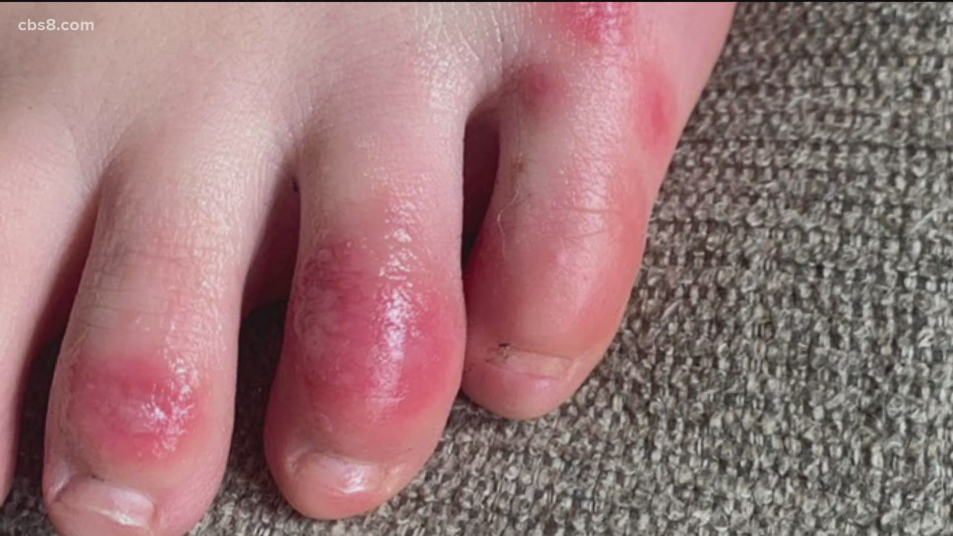 painful-red-itching-and-blistered-toes-it-might-be-chilblains-foot