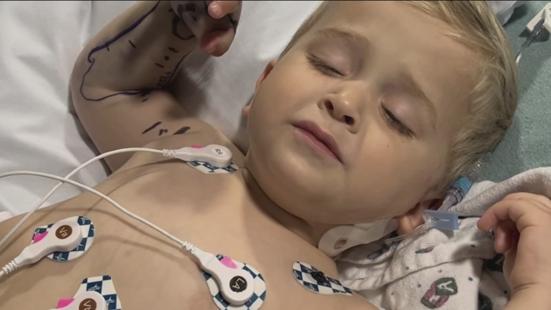 Weeks after the bite, two-year-old Briggs depends on his left hand for a snack or to play with his toys, unable to fully use his right hand.