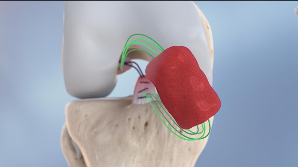 scripps-clinic-debuts-new-implant-to-heal-knee-ligament-tears-cbs8