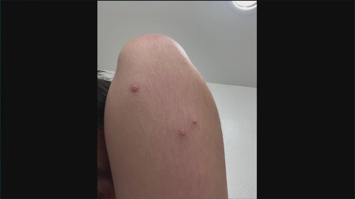 'It's an ugly, painful monster' San Diego man infected with monkeypox