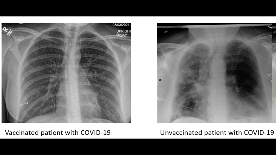 How do lung Xrays look between the vaccinated and unvaccinated?