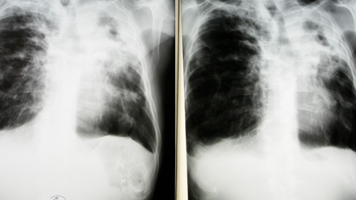 Tuberculosis case reported at National City Boys and Girls Club - Vimarsana News