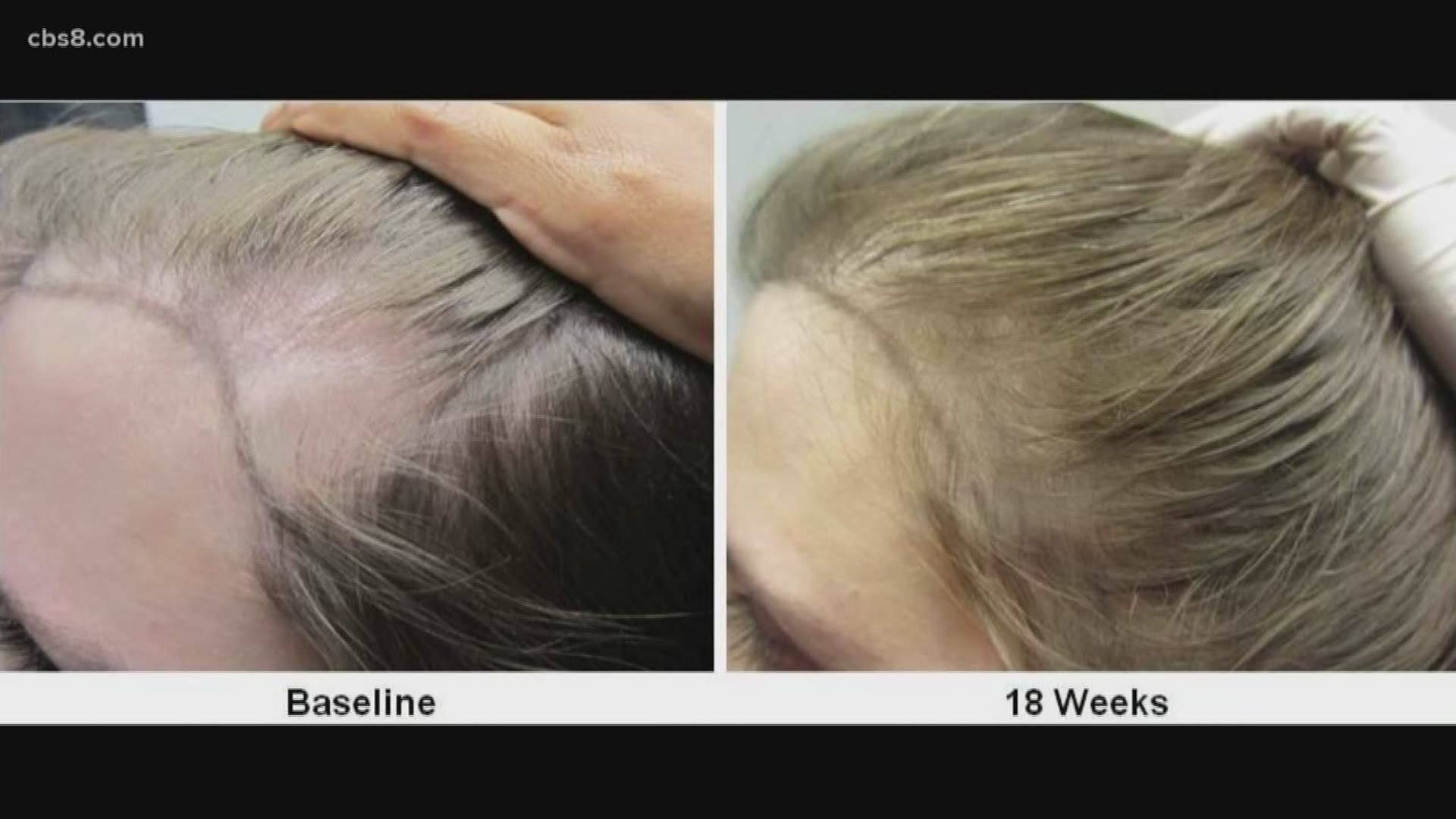San Diego biotech company testing stem-cell cure for baldness 