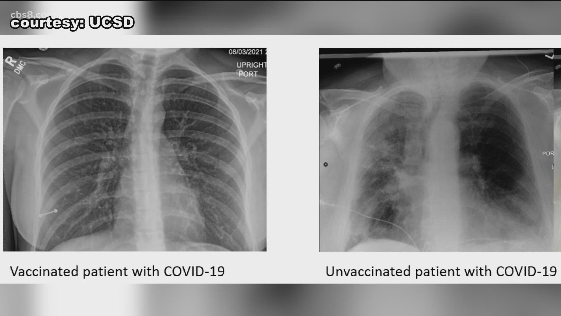 The unvaccinated X-ray shows severe lung damage.
