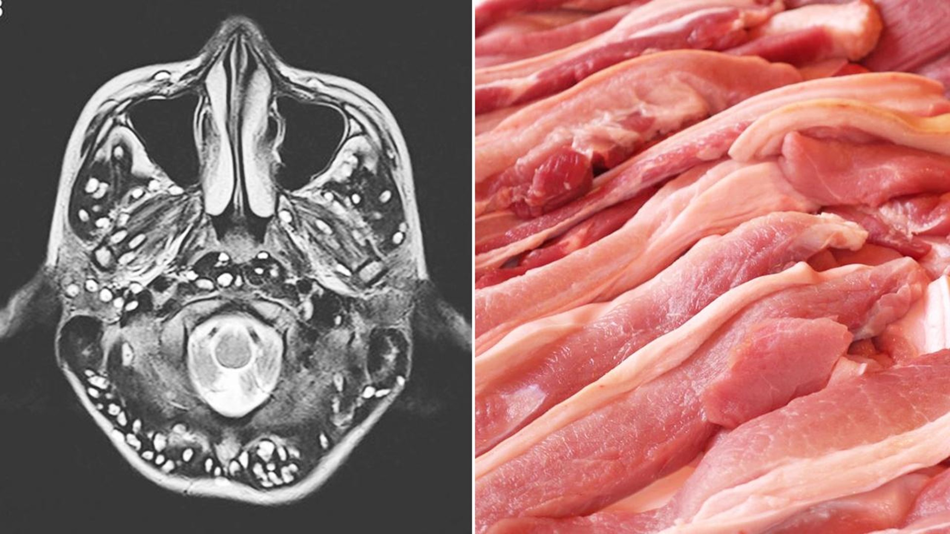 Teen Dies After Eating Undercooked Pork