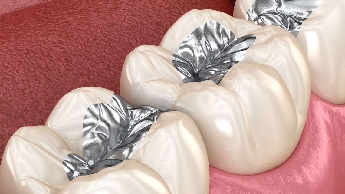 Mercury dental amalgam fillings are safe for most people - Vimarsana News