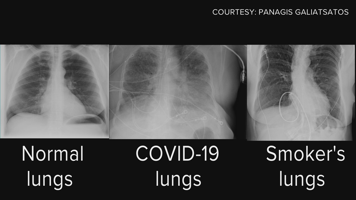 shortness of breath vaccine side effect